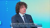 Alopecia areata, cos'è e come si cura