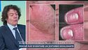 Eczema cronico della pelle, cos'è e come si cura