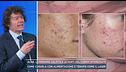 Acne, le persone colpite e le parti del corpo interessate