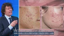 Acne, le persone colpite e le parti del corpo interessate