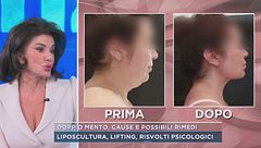 Doppio mento, cause e possibili rimedi