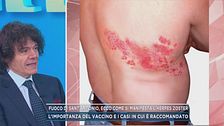 Fuoco di Sant'Antonio, ecco come si manifesta l'herpes Zoster