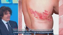 Fuoco di Sant'Antonio, ecco come si manifesta l'herpes Zoster