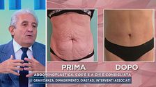 Addominoplastica, cos'è e a chi è consigliata