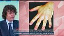 Verruche, cosa sono e come combatterle in modo efficace