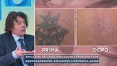 Rimozione tatuaggi, procedure e problematiche