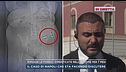 Rimosse le forbici dimenticate nell'addome per 7 mese