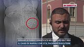 Rimosse le forbici dimenticate nell'addome per 7 mese