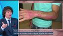 Psoriasi, una malattia della pelle di origine autoimmune