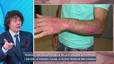Psoriasi, una malattia della pelle di origine autoimmune