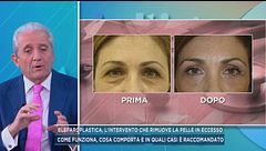 Blefaroplastica, l'intervento che rimuove la pelle in eccesso