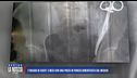 L'incubo di Giusy: 5 mesi con una pinza in pancia dimenticata dal medico