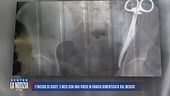 L'incubo di Giusy: 5 mesi con una pinza in pancia dimenticata dal medico