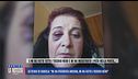 Lo sfogo di Daniela: "Mi ha picchiata ancora, mi ha fatto l'occhio nero"