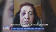 Lo sfogo di Daniela: "Mi ha picchiata ancora, mi ha fatto l'occhio nero"