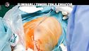 PECORARO: Eliminare i tumori con il ghiaccio