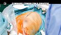 PECORARO: Eliminare i tumori con il ghiaccio