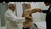 DE GIUSEPPE: Pesava 422 kg, ora fa l'operazione per togliere la pelle in eccesso
