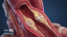 Ep. 5 - Stenosi carotidea