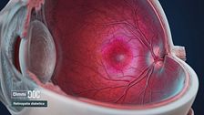 Ep. 10 - Retinopatia diabetica