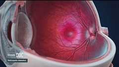 Ep. 10 - Retinopatia diabetica