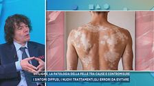 Vitiligine, la patologia della pelle tra cause e contromisure