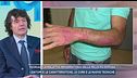 Psoriasi, la malattia infiammatoria della pelle più diffusa