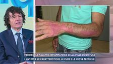 Psoriasi, la malattia infiammatoria della pelle più diffusa