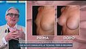 Mastoplastica additiva, l'intervento per rimodellare il seno
