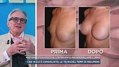 Mastoplastica additiva, l'intervento per rimodellare il seno