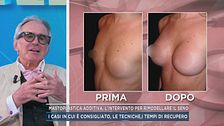 Mastoplastica additiva, l'intervento per rimodellare il seno