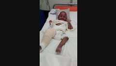 Disabili in Kenya, le gambe di Victor sono tornate diritte