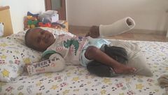 La fisioterapia di Victor, il bambino di cristallo