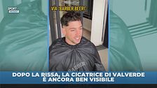 Dopo la rissa, la cicatrice di Valverde è ancora ben visibile